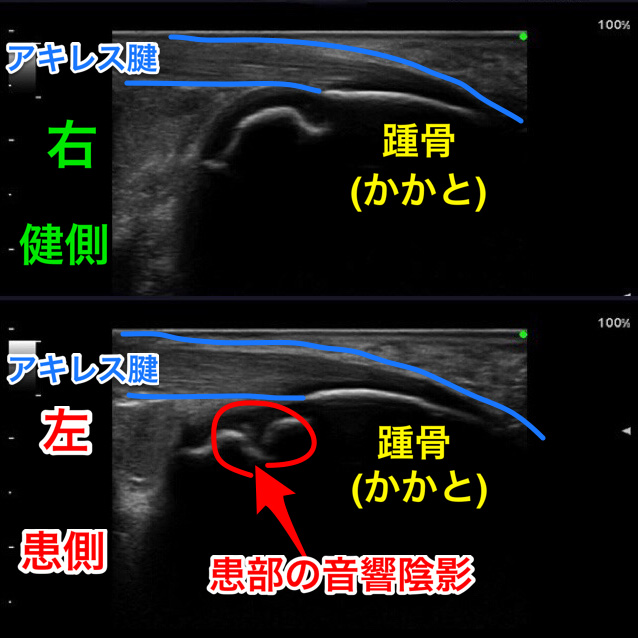 滋賀県東近江市八日市の整骨院・鍼灸院 てらい整骨院シーバー病 症例